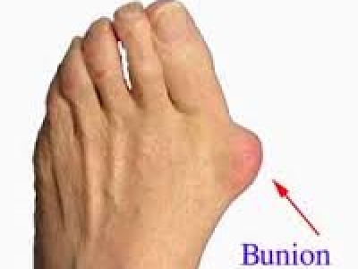 Bunions Causes and Treatment